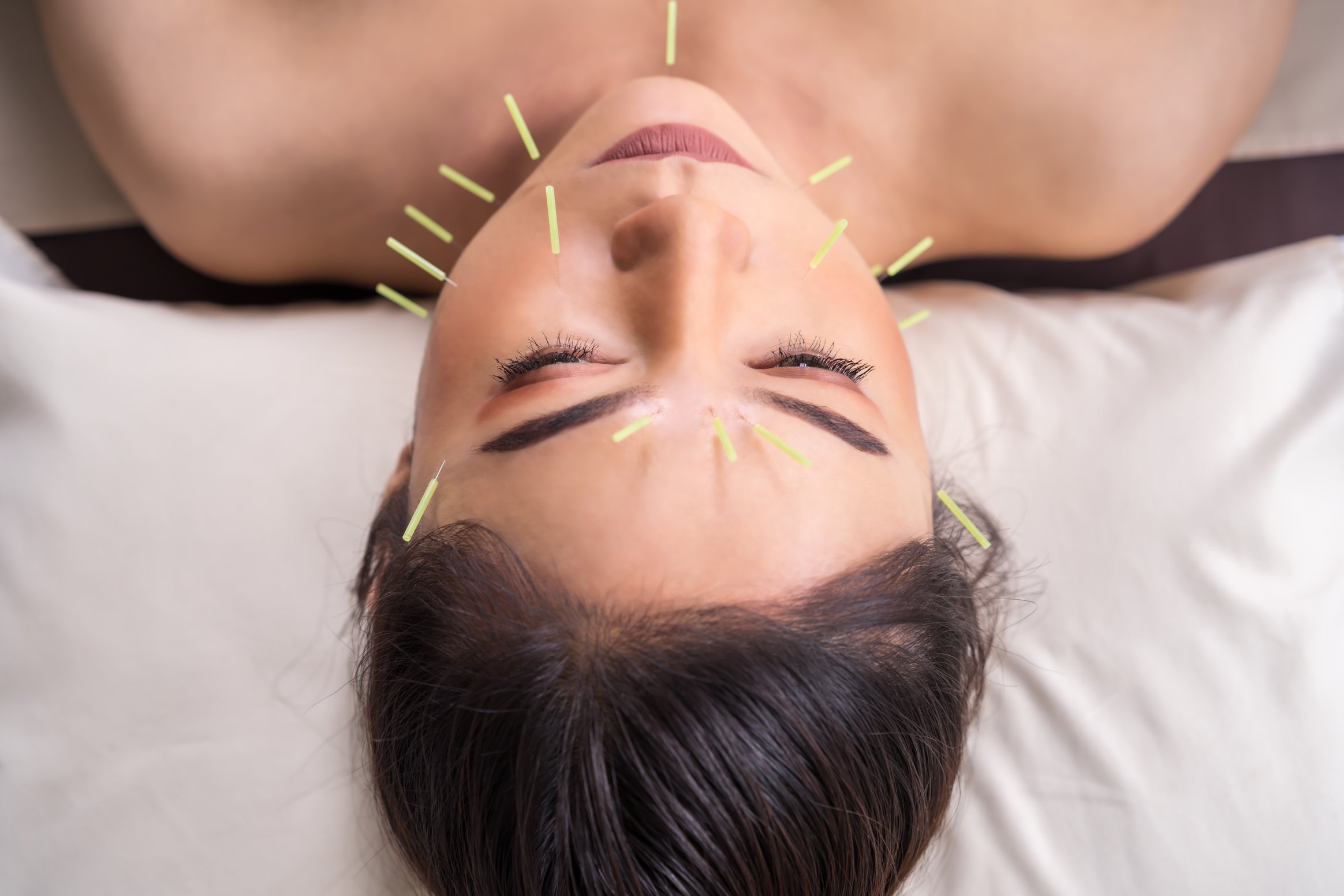 woman undergoing acupuncture treatment on face