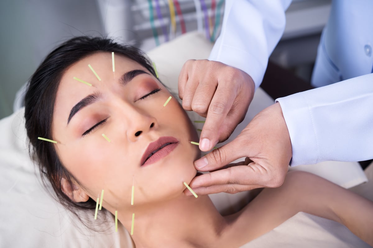 woman undergoing acupuncture treatment on face